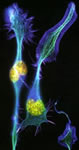 Neurona. Nueroblastoma en diferenciación.